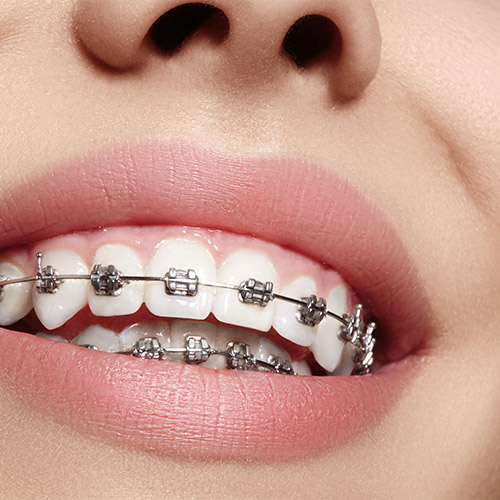Orthodontics & Invisalign Treatment in Edmonton