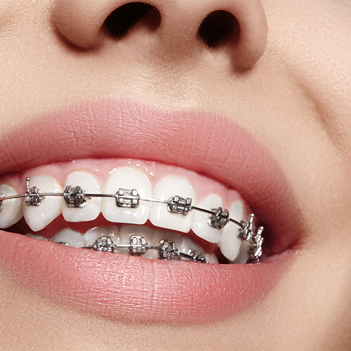 https://southgatedentalcentre.com/wp-content/uploads/2018/03/SouthGate-BracesInvisalign-SupportingImage-2.jpg