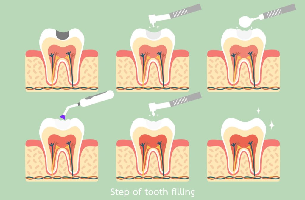 How Long Does a Cavity Filling Take