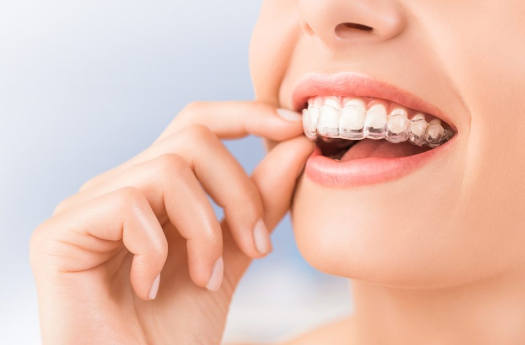 A woman putting in her Invisalign to fix her misaligned teeth