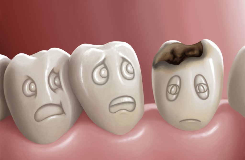 A cartoon illustration of three teeth with faces, two of them with facial expressions of fear and worry looking towards the third being an infected tooth with a look of sadness