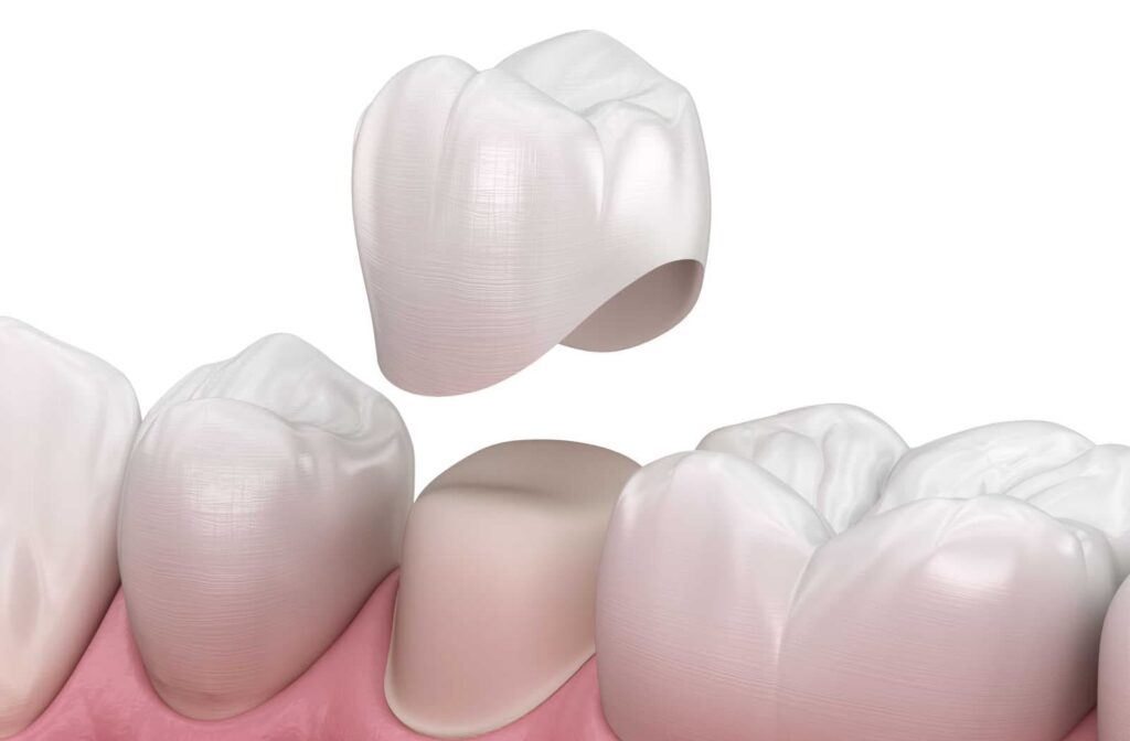 A rendered image of a dental crown being used to restore a damaged or decayed tooth