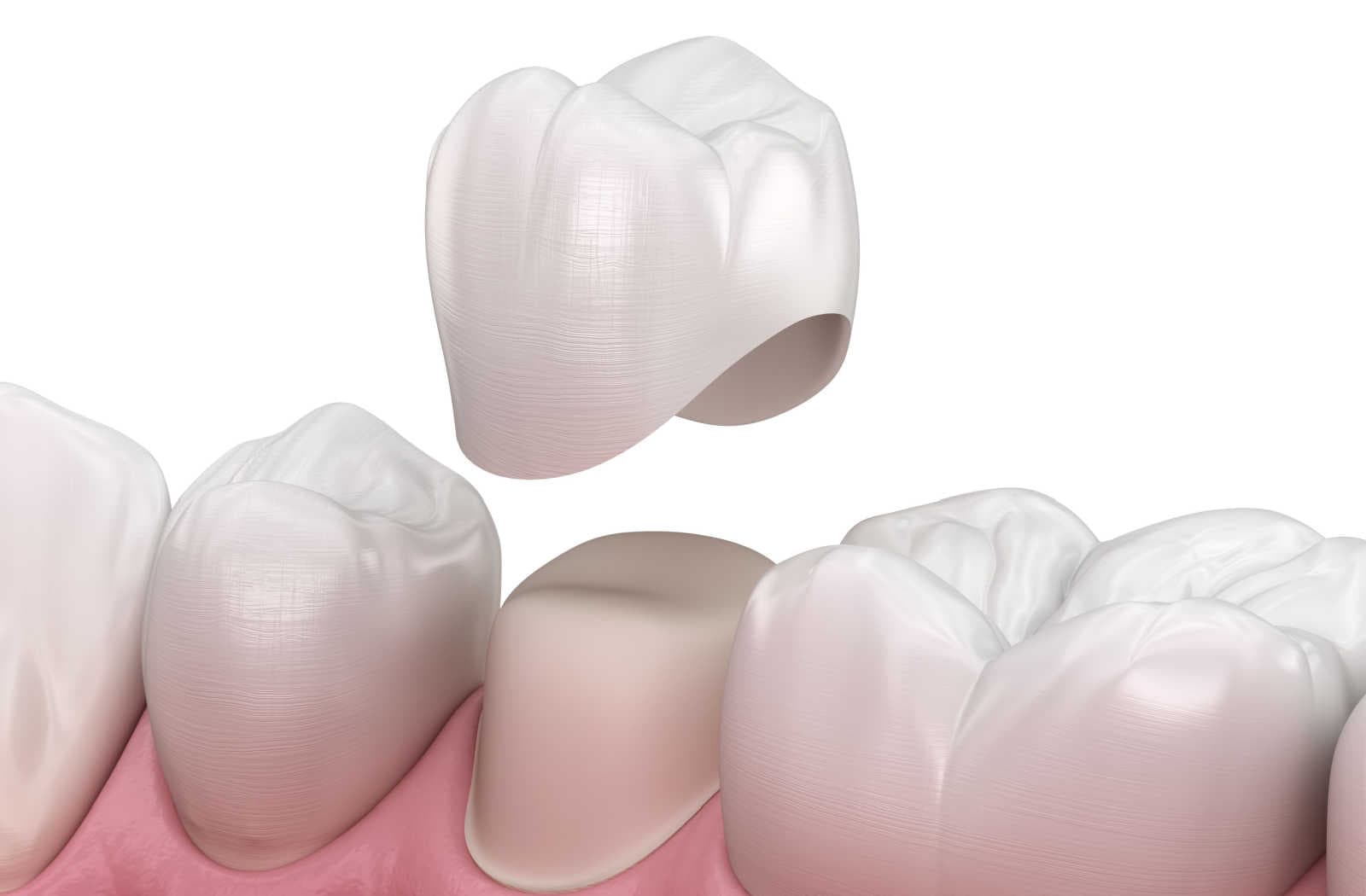 Can Dental Crowns Be Replaced? Edmonton Southgate Dental