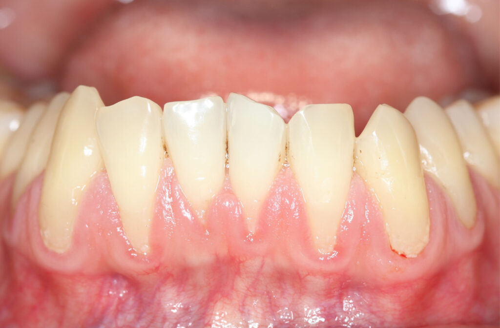 A close up of a mouth and bottom teeth showing gum recession due to biological factors like plaque build up.