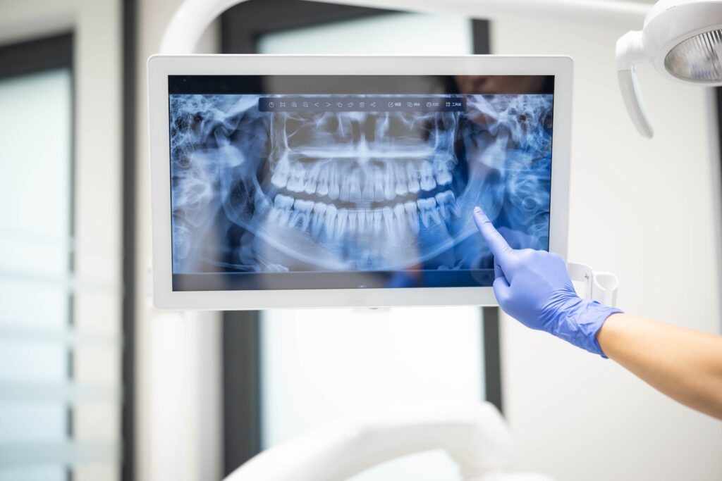 A dentist point to a dental x-ray on a screen during a dental recall exam.